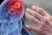 متخصص مغز و اعصاب درباره برخی نشانه ها در جوانان که احتمال ابتلا به پارکینسون یا بیماری های دیگر عصبی می‌دهد، توضیح داد.